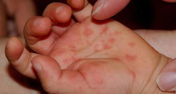 هذه أعراض فيروس “كوكساكي” المنتشر بكثافة في لبنان