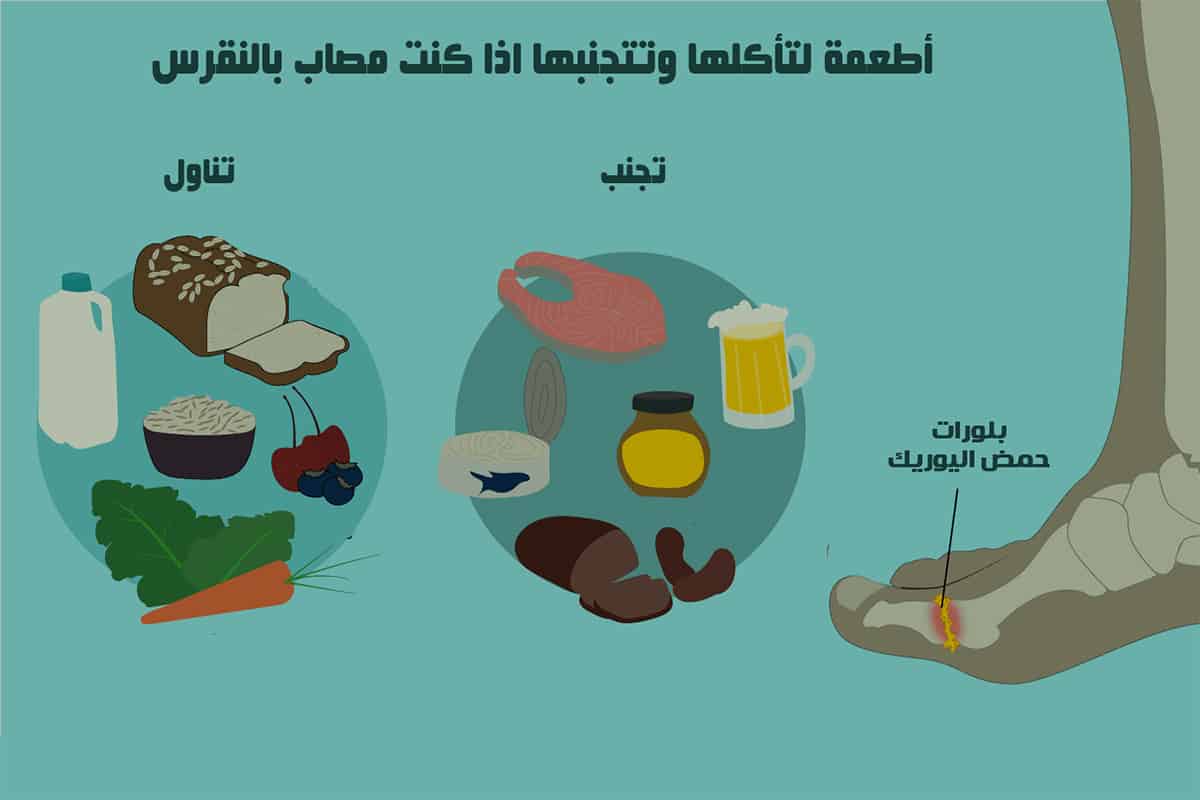 أطعمة تزيد حمض اليوريك في الجسم وتسبب النقرس